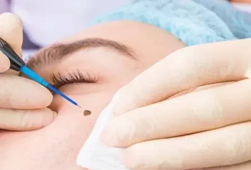 از بین بردن خال صورت در یک روز در خانه ممکن است؟! ( از بین بردن خال گوشتی + سطحی )