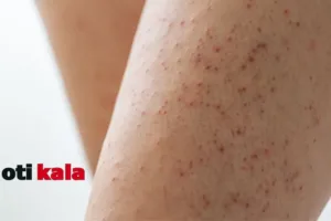 پاهای فردی که دچار پوست مرغی شده