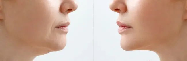تفاوت صورت یک زن قبل و بعد از تزریق پروفایلو