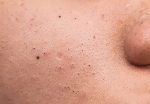 علت جوش سر سیاه + راه های خلاصی از جوش سرسیاه بینی