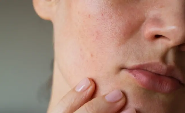 شخصی در حال بررسی علت جوش روی بینی و لب