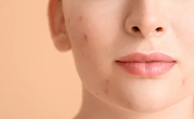 تعدادی جوش روی چانه و فک یک شخص