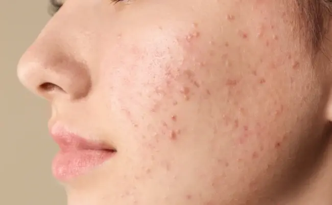 تعدادی جوش روی گونه یک شخص