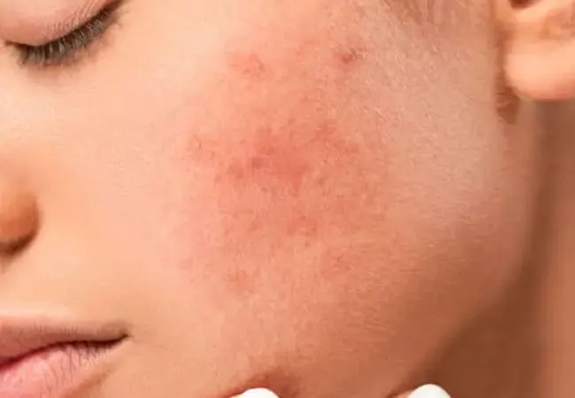 گونه زنی با جوش زیرپوستی