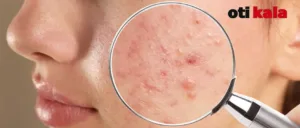 جوش‌های زیرپوستی زنی زیر ذره بین