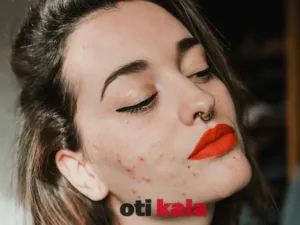 زنی با جوش روی گونه