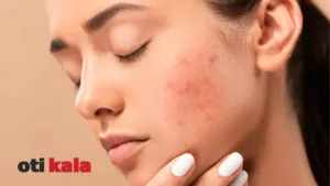 زنی با جوش روی گونه