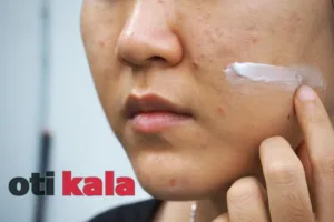 زنی در حال زدن کرم ترمیم کردن جای جوش به صورت