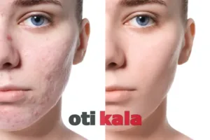 مقایسه قبل و بعد صورت فردی بعد از رفتن لک های صورت
