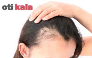 زنی در حال بررسی قسمت های دارای ریزش مو در سرش