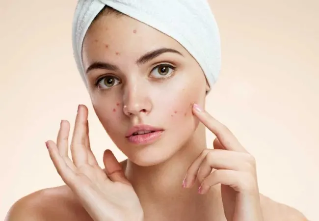 علت لک صورت ( از بین بردن لک صورت در خانه + معرفی محصولات )