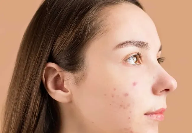 زنی دارای لک صورت روی گونه