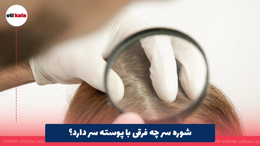 شوره سر چه فرقی با پوسته سر دارد؟
