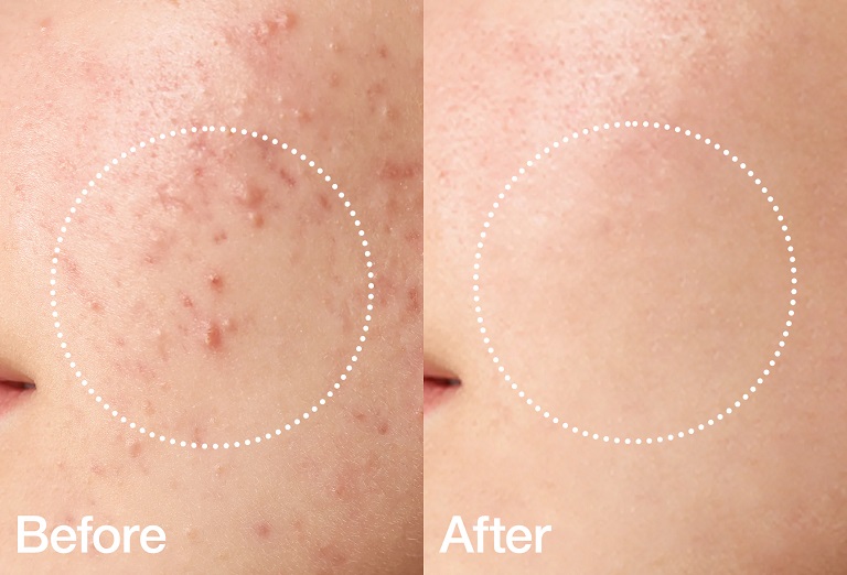 تونر لایه بردار و کنترل منافذ آنوا Anua BHA 2% Gentle Exfoliating Toner