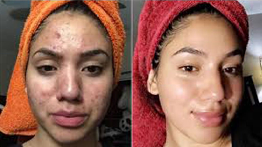 پاکسازی پوست چرب و جوش‌دار در منزل